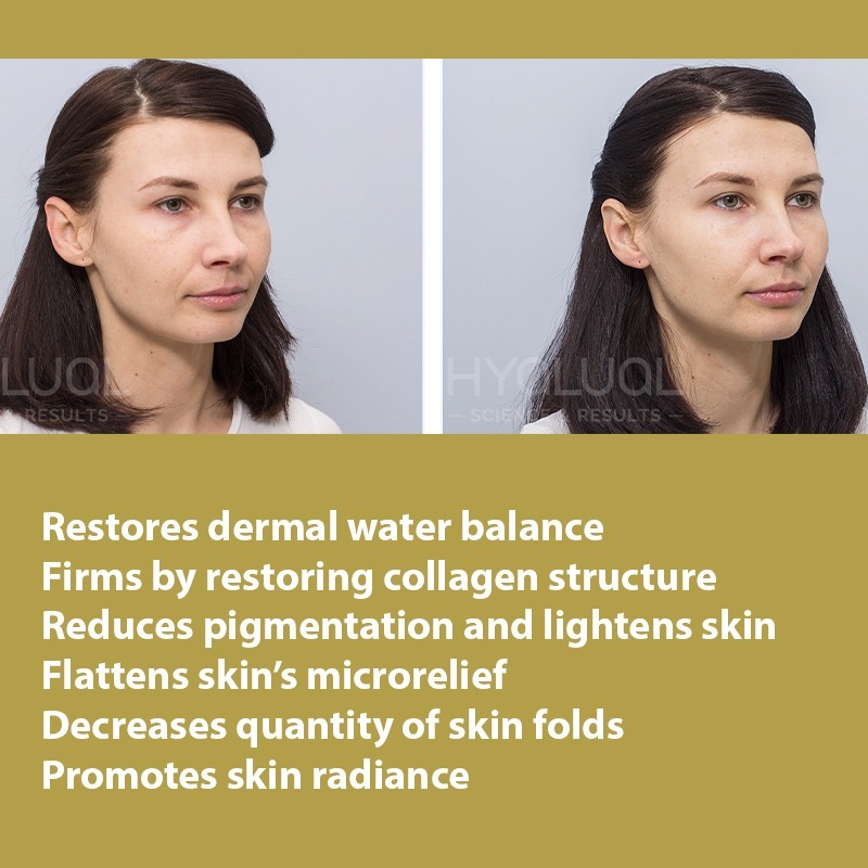 HYALUAL Xela Rederm 1.8