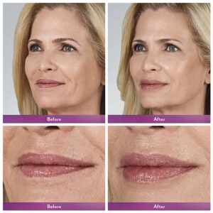Juvederm ® Ultra 3 with Lidocaine