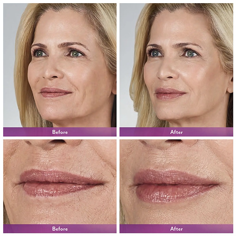 Juvederm ® Ultra 3 with Lidocaine