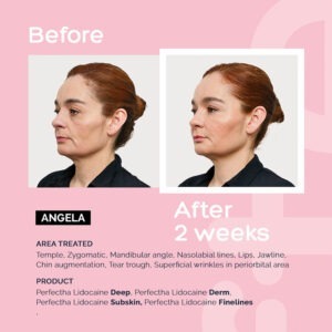 Perfectha Deep without lidocaine