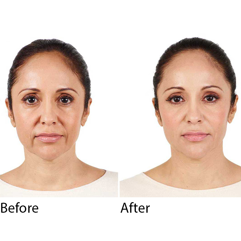 Radiesse Lifting & Volume Filler