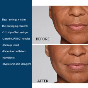 3Restylane® Defyne Lidocaine