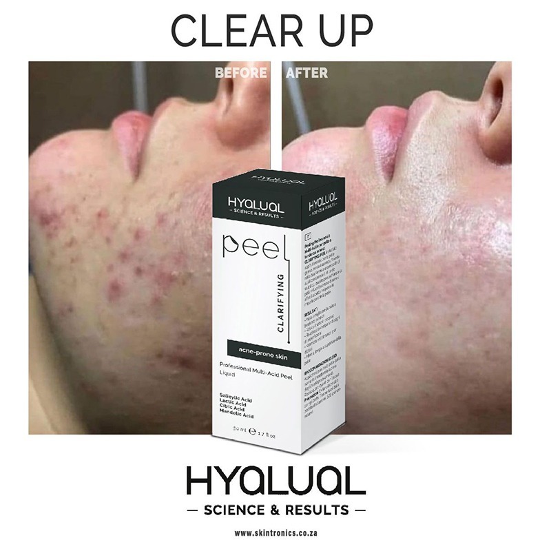 HYALUAL Clarifying Peel