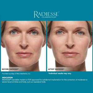 Radiesse with Lidocaine – Lifting & Volume Filler