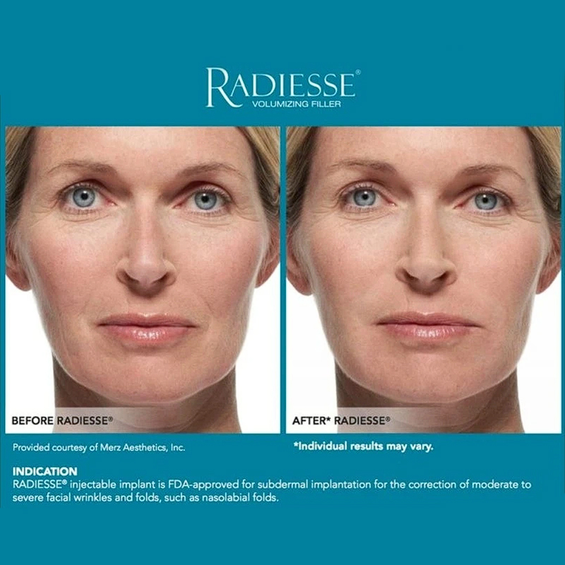 Radiesse with Lidocaine – Lifting & Volume Filler