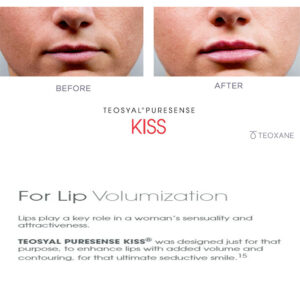 Teoxane Puresense Kiss