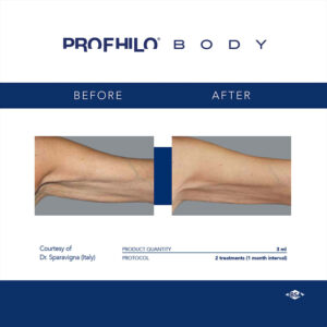 Profhilo Body