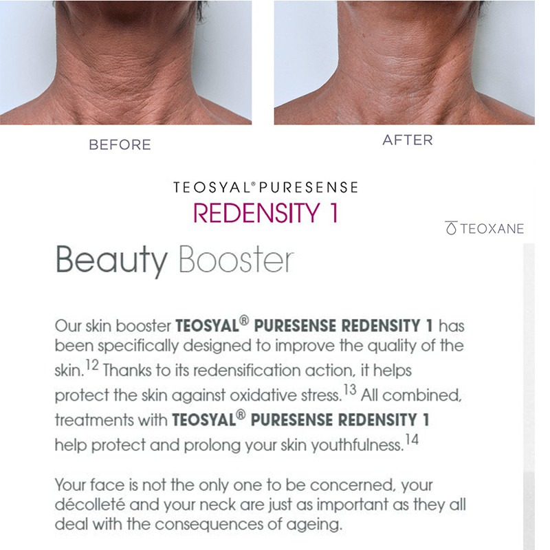 Teoxane Teosyal Redensity 1 2x1ml