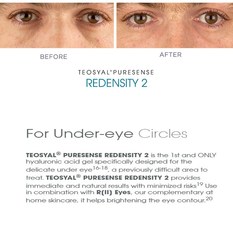 Teoxane Teosyal Redensity 2