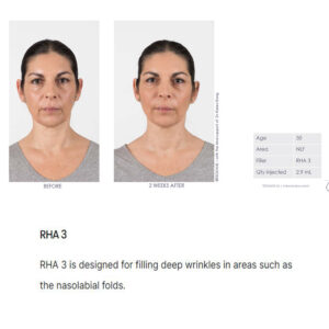 Teoxane Teosyal RHA 3