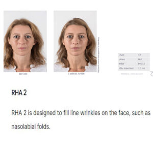 Teoxane Teosyal RHA 2