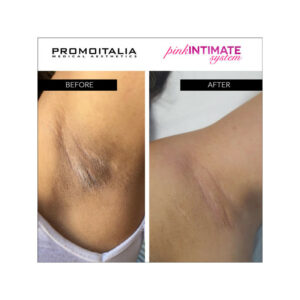 Promoitalia Pink Intimate Peeling
